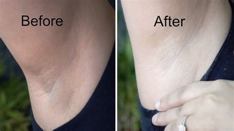 Natural Ways To Get Rid Of Dark Underarms Overnight Fast