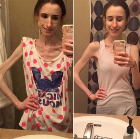 Las Sorprendentes Imágenes De Personas Que Le Ganaron A La Anorexia Soy502