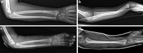 Proximal Forearm Fracture