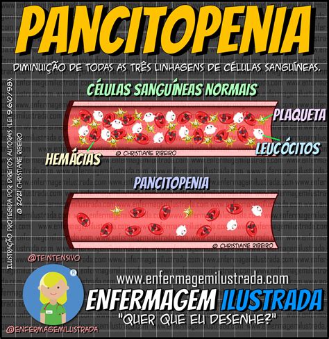 Pancitopenia O Que é Enfermagem Ilustrada