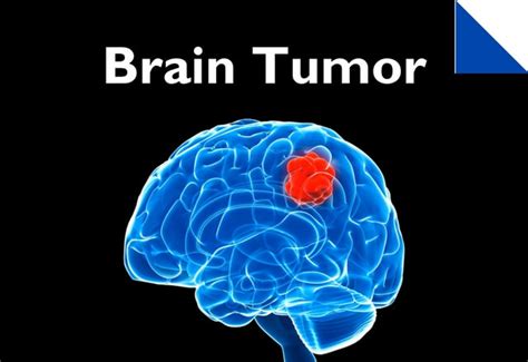 Diagnostic Des Tumeurs Cérébrales Johns Hopkins Comprehensive Brain