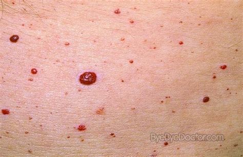 They are skin spots containing a deep red color which reflects the cherry angiomas usually occur in individuals as they age. Chapter 10 at Madonna University - StudyBlue
