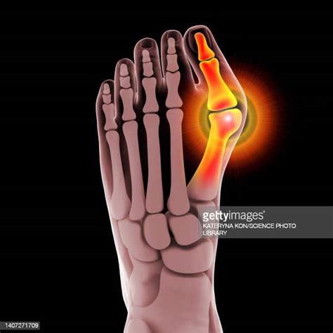 Toe Deformity Photos And Premium High Res Pictures Getty Images