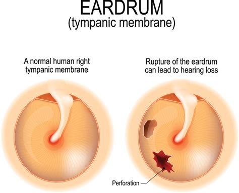 Ear Drum Perforation Surgery