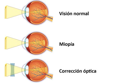 Graus De Miopia Tabela