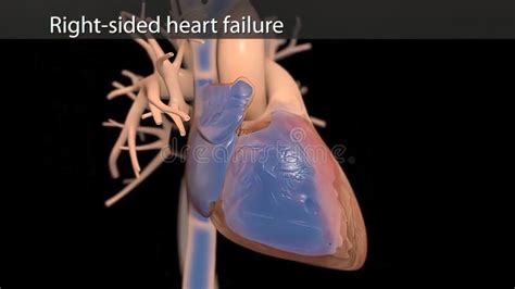Illustration Congestive Heart Failure Stock Illustration Illustration