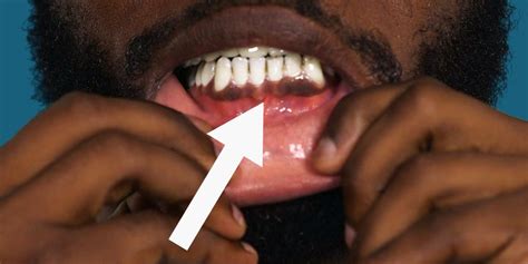 Heres Why Some People Have Black Gums