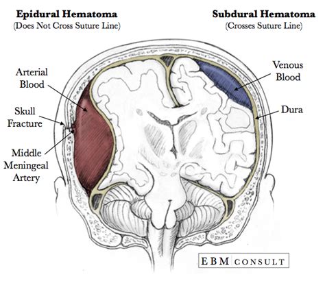 Anatomy Epidural Vs Subdural Hematoma Image