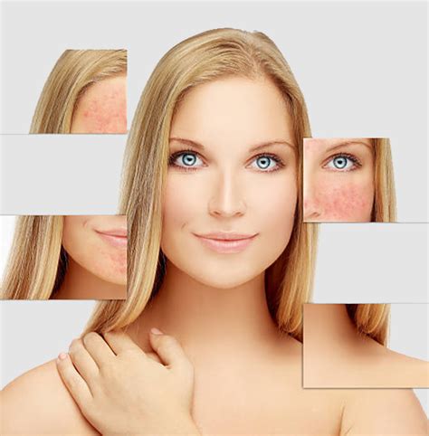 Rosacea Treatment Skin Clinic Oswestry Improve Your Skin
