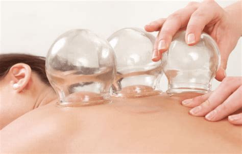 Cupping Therapy Orthopedic Center For Sports Medicine Sports Medicine