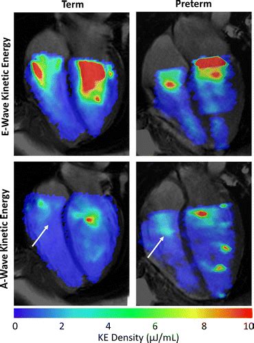 Altered Right Ventricular Filling At Four Dimensional Flow Mri In Young
