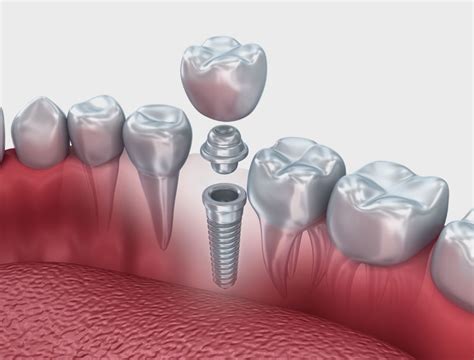 Implantologia Carico Immediato Denti Fissi In Giornata