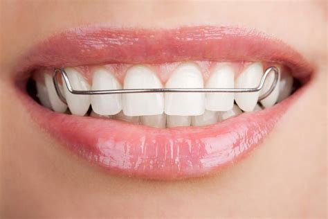 Пластины для выравнивания зубов: разновидности, показания и ...