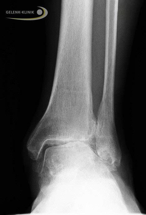 Malunion Ankle Fracture Early Treatment Prevents Arthrosis Joint