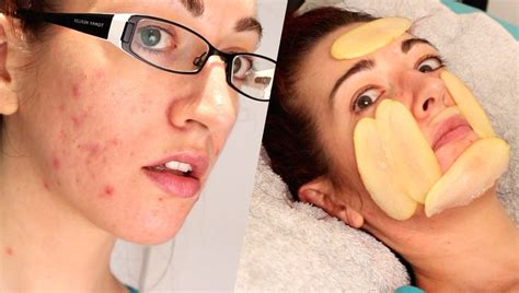 How To Fade Acne Scars With Potato Natural Mild Scarring