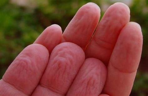 Wrinkled Fingertips Causes Treatment Pain Redness Lupus Thyroid