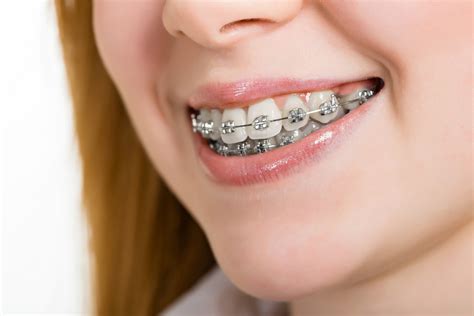 Traditional Metal Braces Charlotte Orthodontist Crown Point