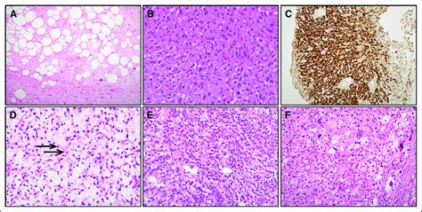 Histologic Appearance Of Liposarcoma Subtypes A Hematoxylin And