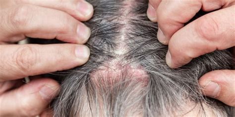 Share More Than 149 Itchy Scalp Hair Loss Latest Vn