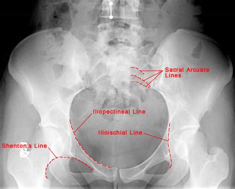 Pelvis Anatomy Xray