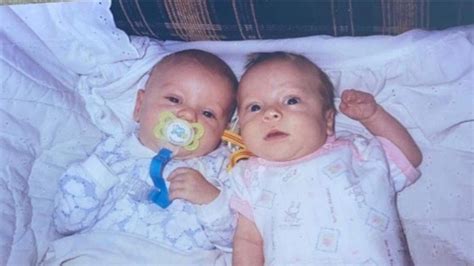 Parent Spotlight Raising Twins One Born With Amniotic Band Syndrome