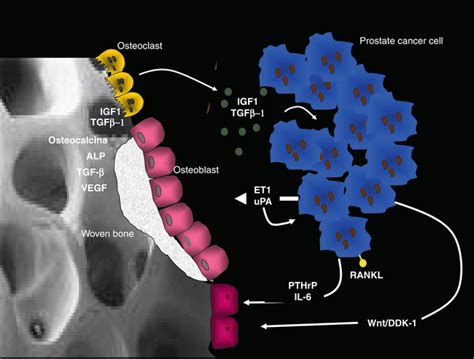 Biology And Pathophysiology Of Bone Metastasis In Prostate Cancer