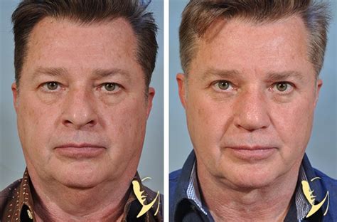 Upper And Lower Eyelids Facelift Robinson Fps