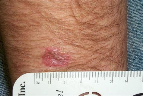 Derm Dx Asymptomatic Lesion On The Forearm Dermatology Advisor