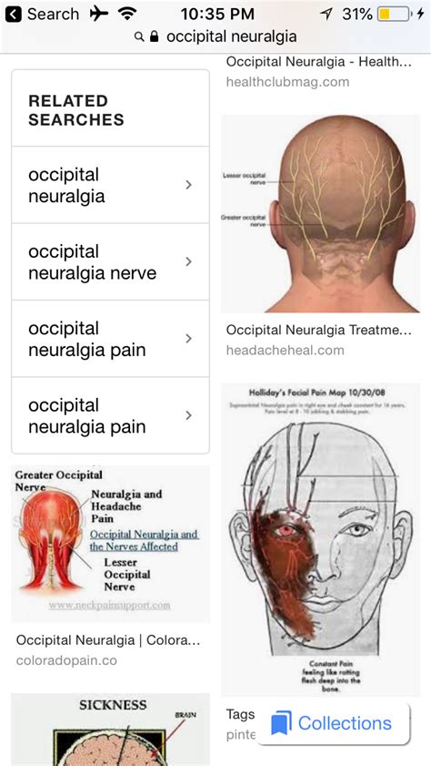 Occipital Neuralgia 10 Causes Of Occipital Neuralgia Kulturaupice