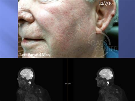Metastatic Squamous Cell Carcinoma Skin Cancer And Reconstructive