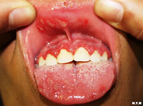 Blisters Under Tongue