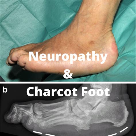 Foot Care Certification Ce Credits For Nurses And Other Professionals