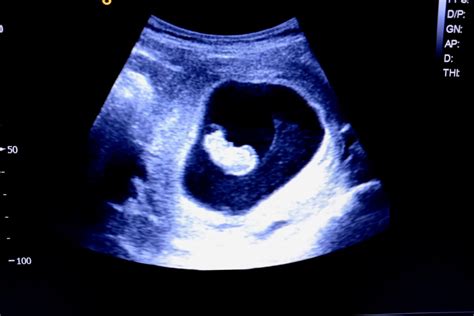 Semana 9 Del Embarazo Síntomas Desarrollo Del Bebé Y Recomendaciones