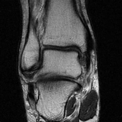 In this weeks video, we have a look at muscle edema in the intrinsic and plantar muscles of the foot and what it can mean.patreons can access original dicom. MRI of the foot radiopedia