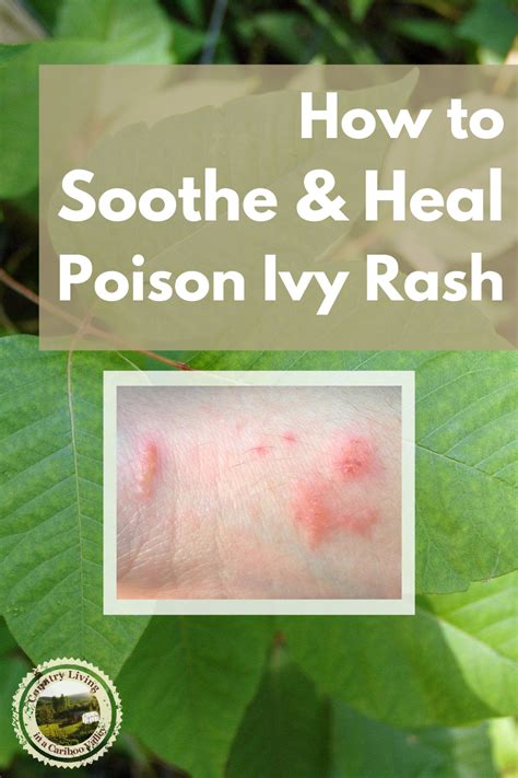 Poison Ivy Rash On Baby