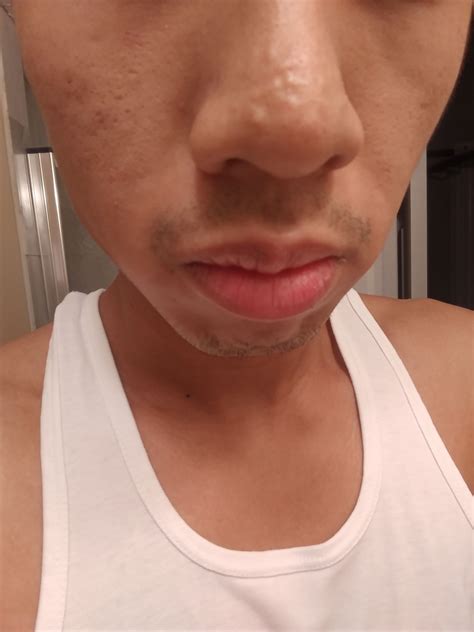 Skin Concerns How Do I Get Rid Of These Bumps On My Nose Working