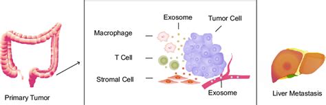 Exosomes In Liver Metastasis Of Colorectal Cancer Stromal Cell Derived