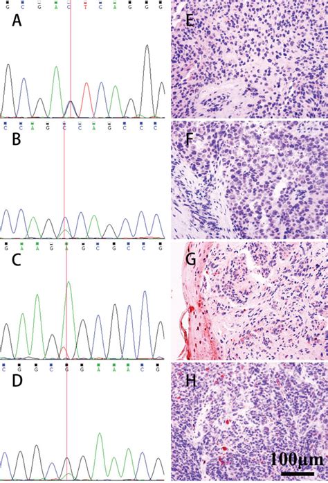 Maybe you would like to learn more about one of these? Loss of nuclear BAP1 expression is associated with poor ...
