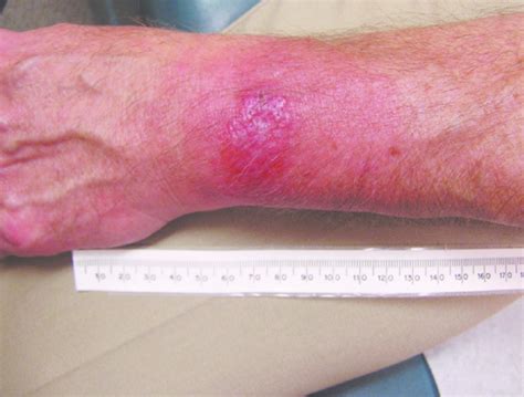 Figure Atypical Erythema Migrans Lesion On A Patient With Pcr Positive
