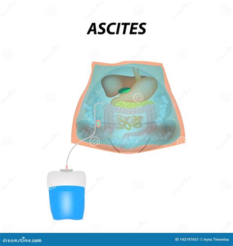 Ascites Free Fluid In The Abdominal Cavity Infographics Vector