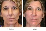 Face Lifts Pictures