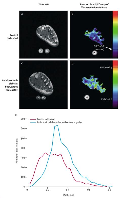 The muscles working on the foot can be distributed within the extrinsic and intrinsic muscles. Foot Muscles Mri / Baxter S Nerve First Branch Of The ...