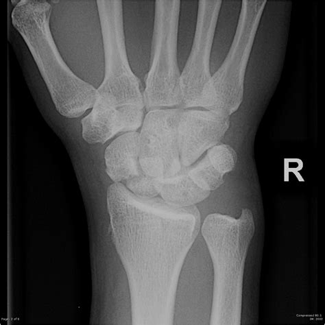 Top Pictures Normal X Ray Of Hand And Wrist Sharp