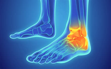 Ankle Fracture Treatment Sport Orthopedics Dallas And Frisco Tx