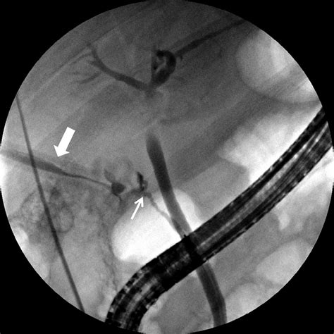 Cholangiogram Performed During Ercp Demonstrates Cystic Duct Stump