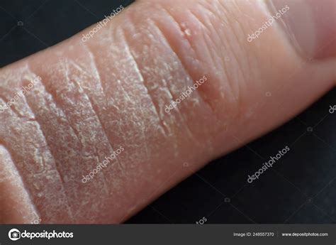 Hand Interdigital Dermatitis Dyshidrotic Eczema Hand Close Stock Photo