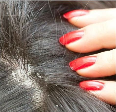 Dandruff is an unsightly problem that afflicts thousands of people at times during their lifetime. 8 DIY Natural Remedies for Dandruff Control - Healthblow.com