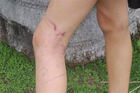 Box Jellyfish Scars On Outside Of Rachael Shardlows Legs In April