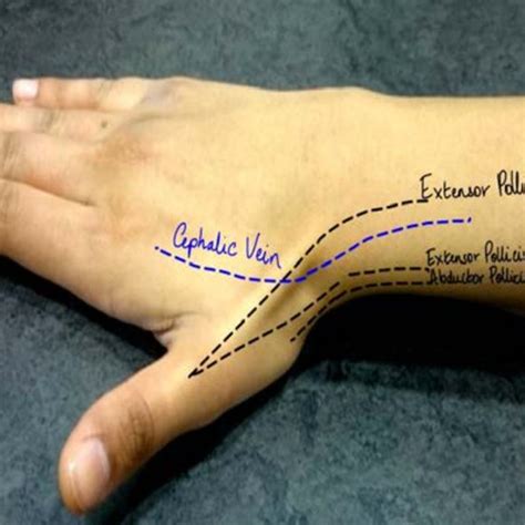 Schematic Diagram Of Volar Extrinsic Wrist Ligaments Rsc Volar