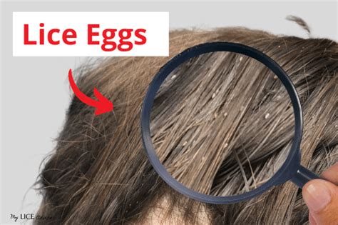 Dead Vs Live Nits Color Of Lice Eggs My Lice Advice